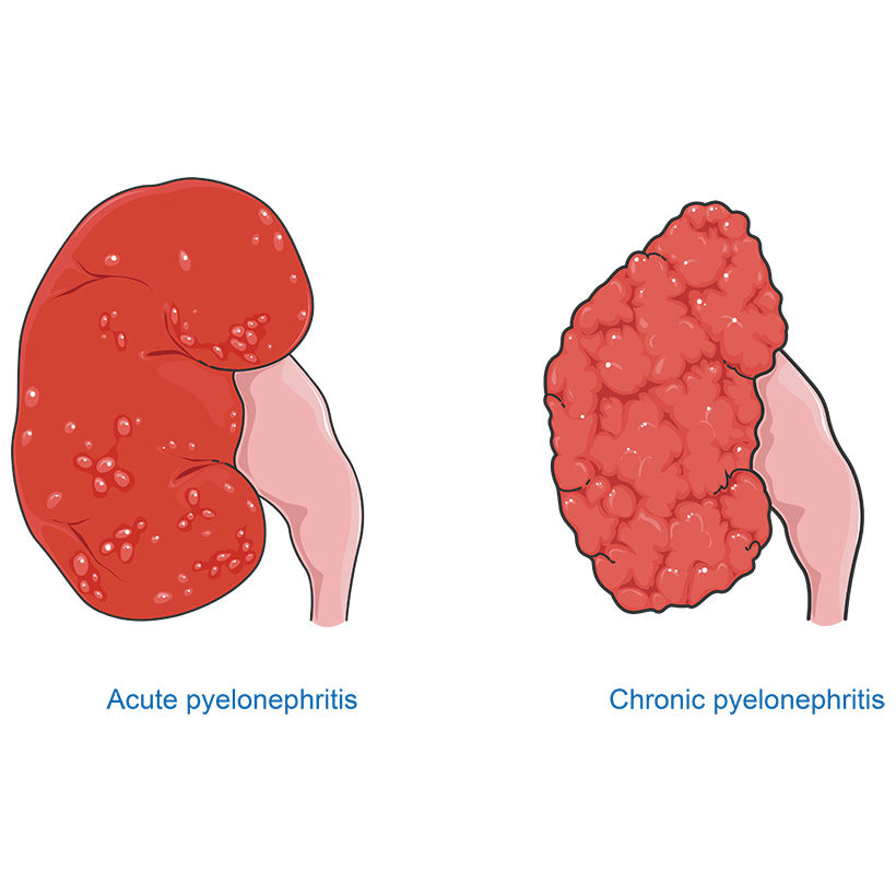 Pyelonephritis Vector