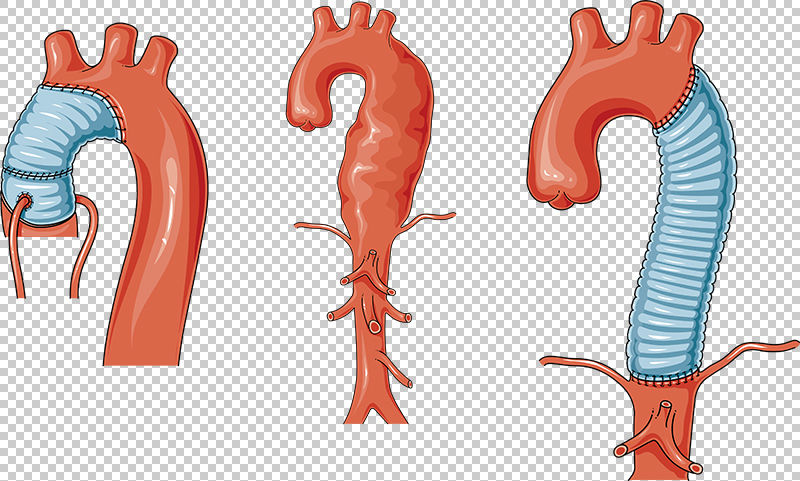 Ilustración científica del vector de aneurisma aórtico torácico