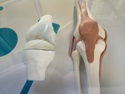 膝关节3D打印模型的假体
