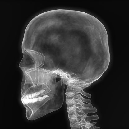 Material 3D de efeito de raio X CT