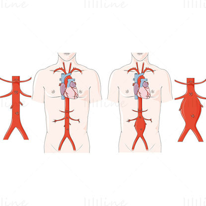Ilustración de vector de aneurisma aórtico abdominal