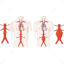 Abdominal Aortic Aneurysm vector illustration