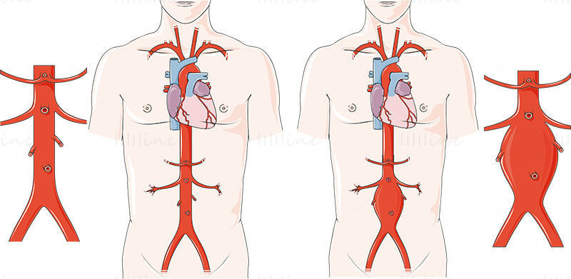 Ilustración de vector de aneurisma aórtico abdominal