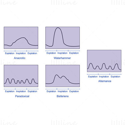 Abnormalities of the arterial pulse vector illustration