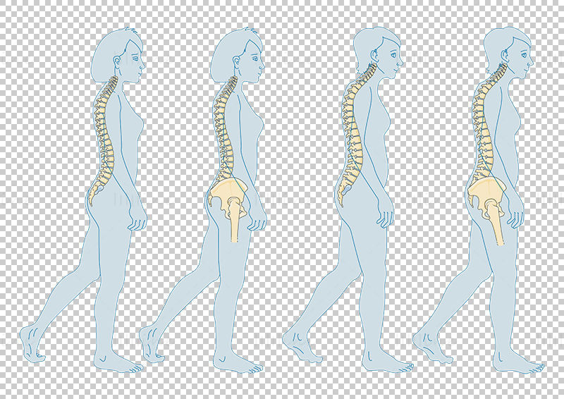 Векторна научна илюстрация на остеопороза при възрастни преди менопауза