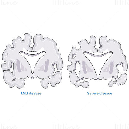 Alzheimer disease vector scientific illustration