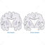 Ilustración científica del vector de la enfermedad de Alzheimer
