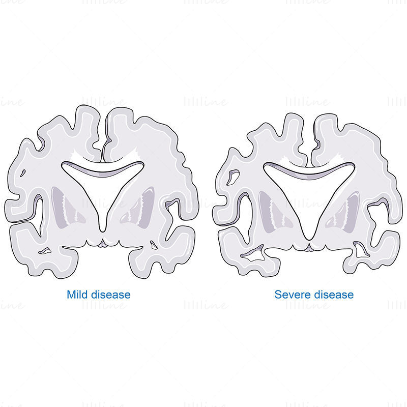 ilustração científica vetorial da doença de alzheimer