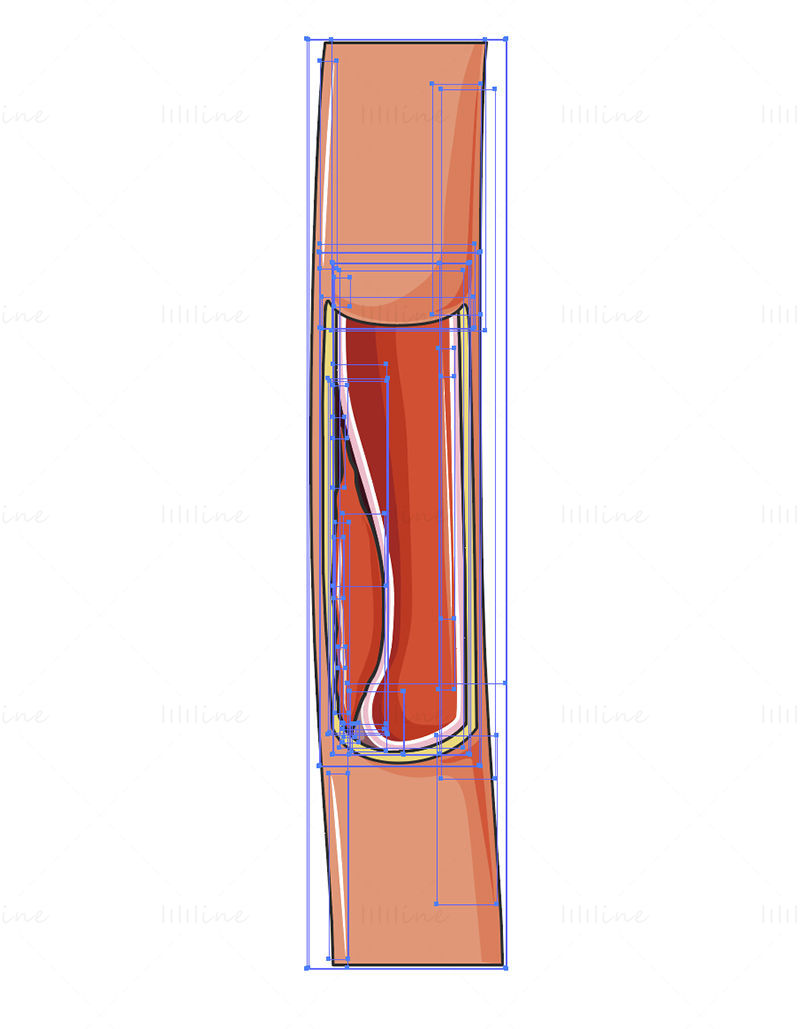 Ilustración de vector de aneurisma