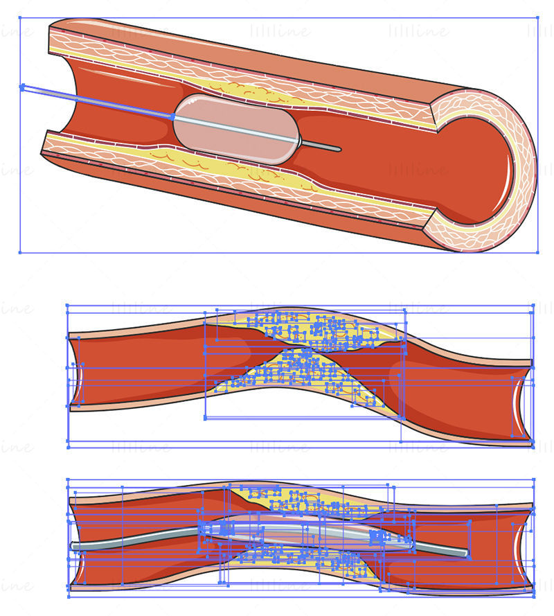Ilustração científica vetorial de angioplastia