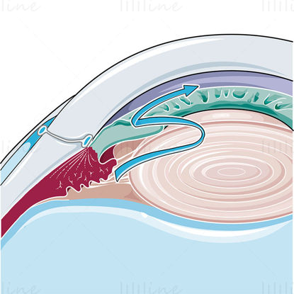 Angle closure glaucoma vector illustration