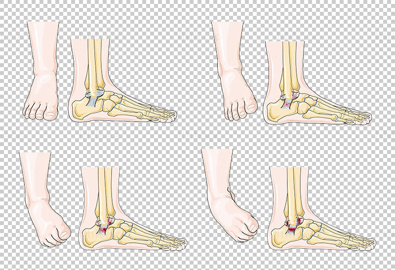 Ankle sprain vector scientific illustration