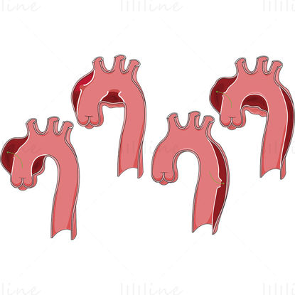 Aortic aneurysms vector illustration
