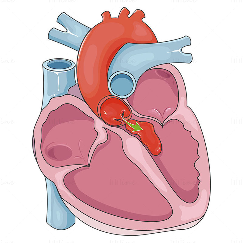 Vettore di rigurgito della valvola aortica