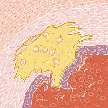 Atherosclerosis vector scientific illustration
