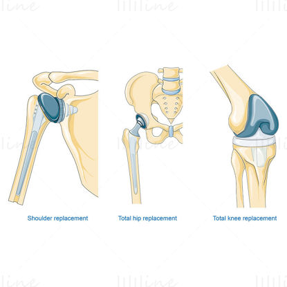 Bone replacement surgery vector illustration
