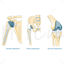 Bone replacement surgery vector illustration