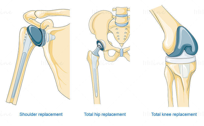 Bone replacement surgery vector illustration