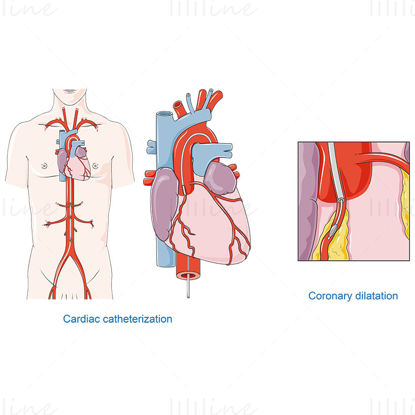 Vettore di cateterismo cardiaco