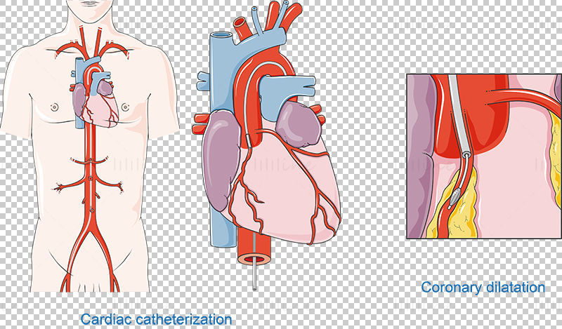 Vektor srdeční katetrizace