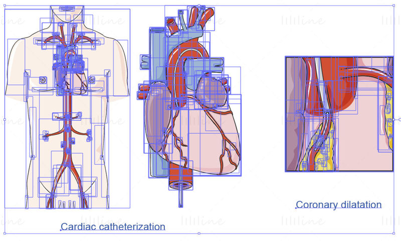 Вектор катетеризации сердца