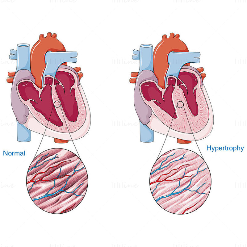 Cardiac hypertrophy vector