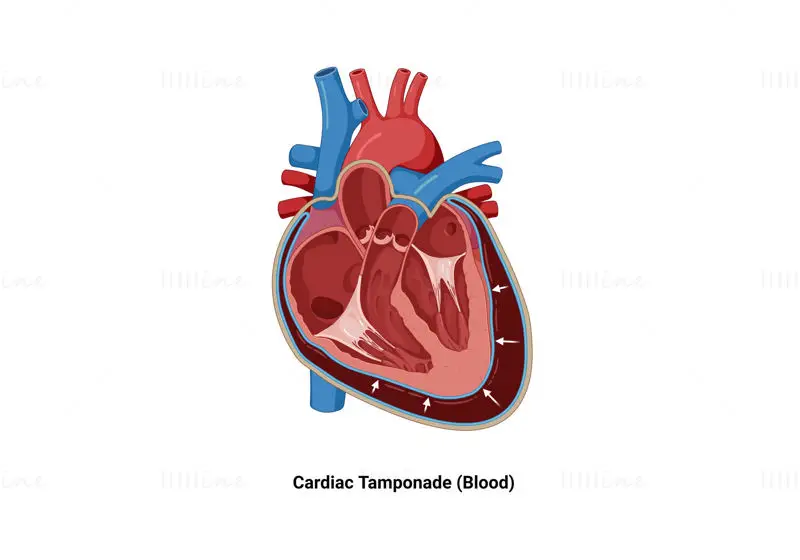 Illustration de tamponnade cardiaque (sang)