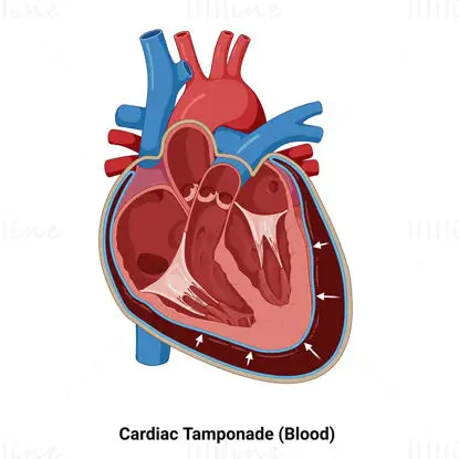 Illustration de tamponnade cardiaque (sang)