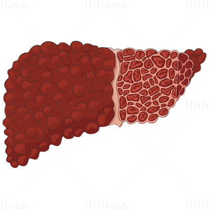 Cirrhosis of the liver vector