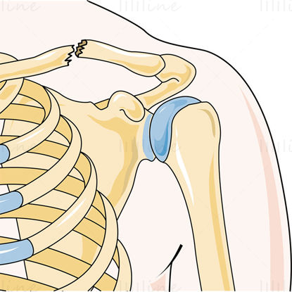 Illustration scientifique de vecteur de fracture de la clavicule