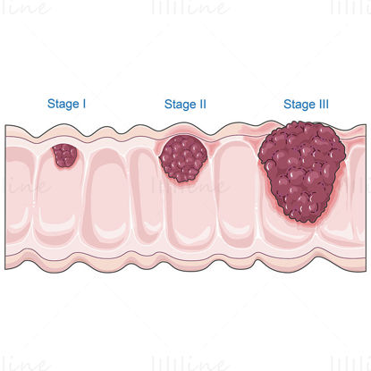 Colon cancer vector scientific illustration