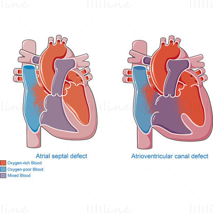 Vektor vrozených srdečních chorob
