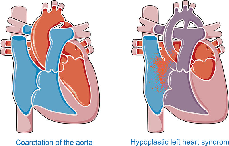 Congenital heart diseases vector