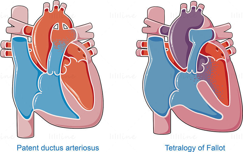 Congenital heart  diseases vector