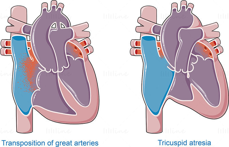Congenital heart  diseases vector