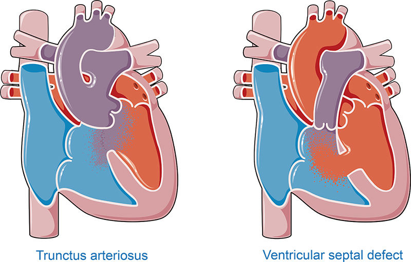 Congenital heart diseases vector