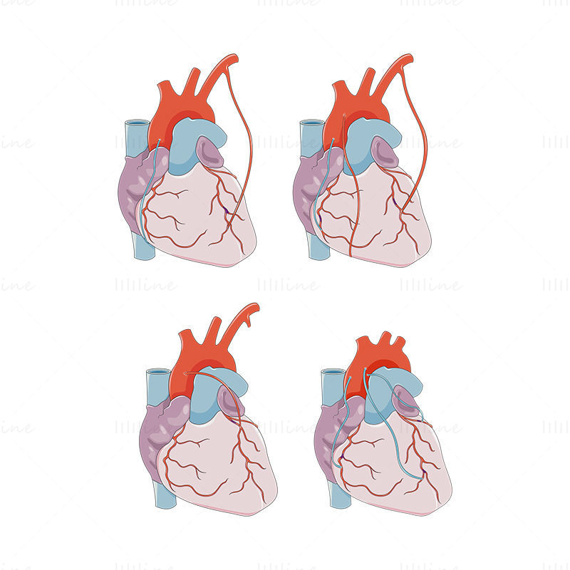 Koronární arteriální bypass Vektor roubování