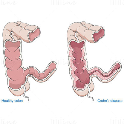 Crohn hastalığı vektörü