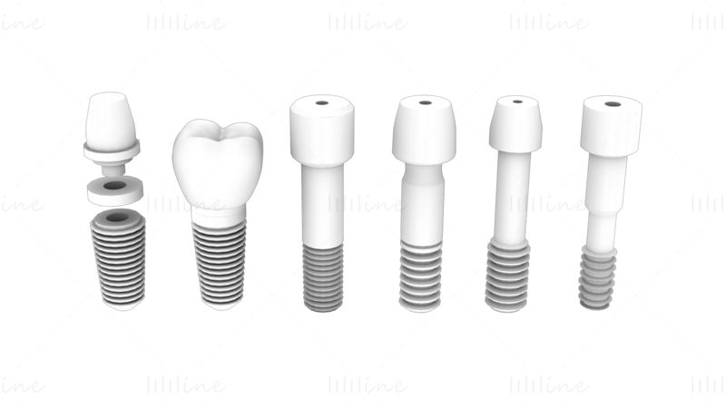 Fogimplantátum 3D modellcsomag – 6 az 1-ben
