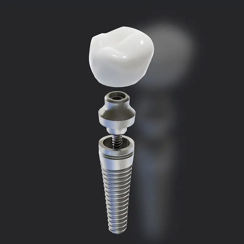 Dental implant medical illustration PNG