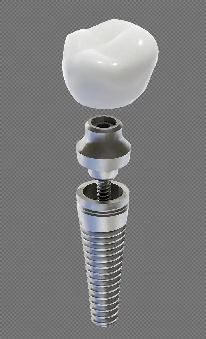 Dental implant medical illustration PNG