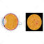 Diabetic retinopathy vector illustration