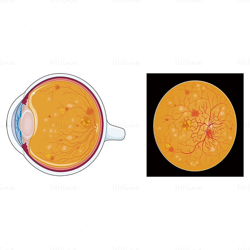 Ilustración de vector de retinopatía diabética