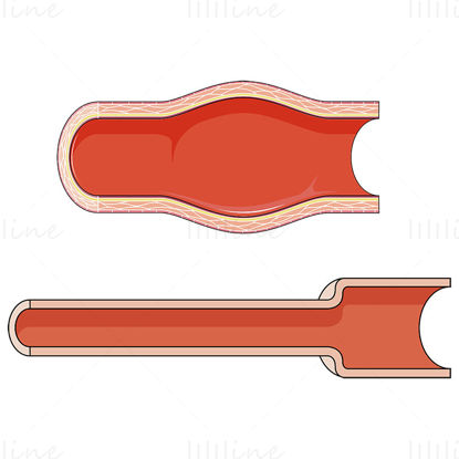 Illustration vectorielle de l'artère dilatée