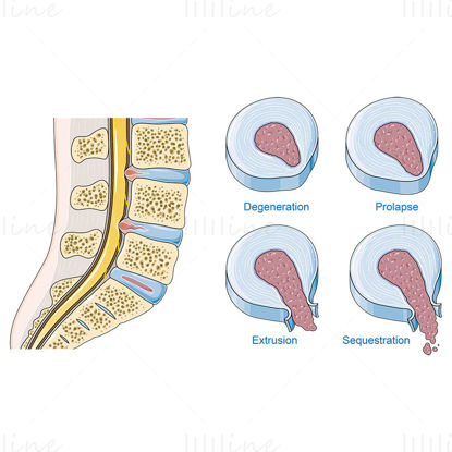 Disc herniation vector scientific illustration