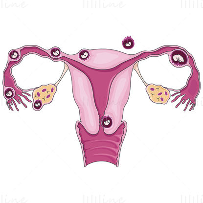 Ectopic pregnancies vector illustration