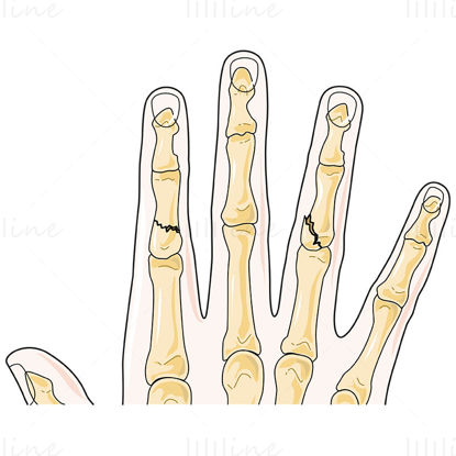 Vecteur de fractures des doigts