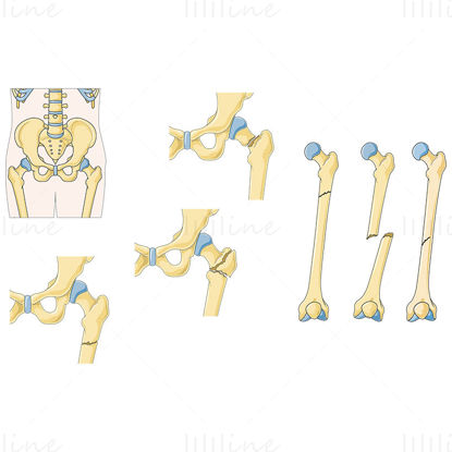 Fracture of femur vector illustration