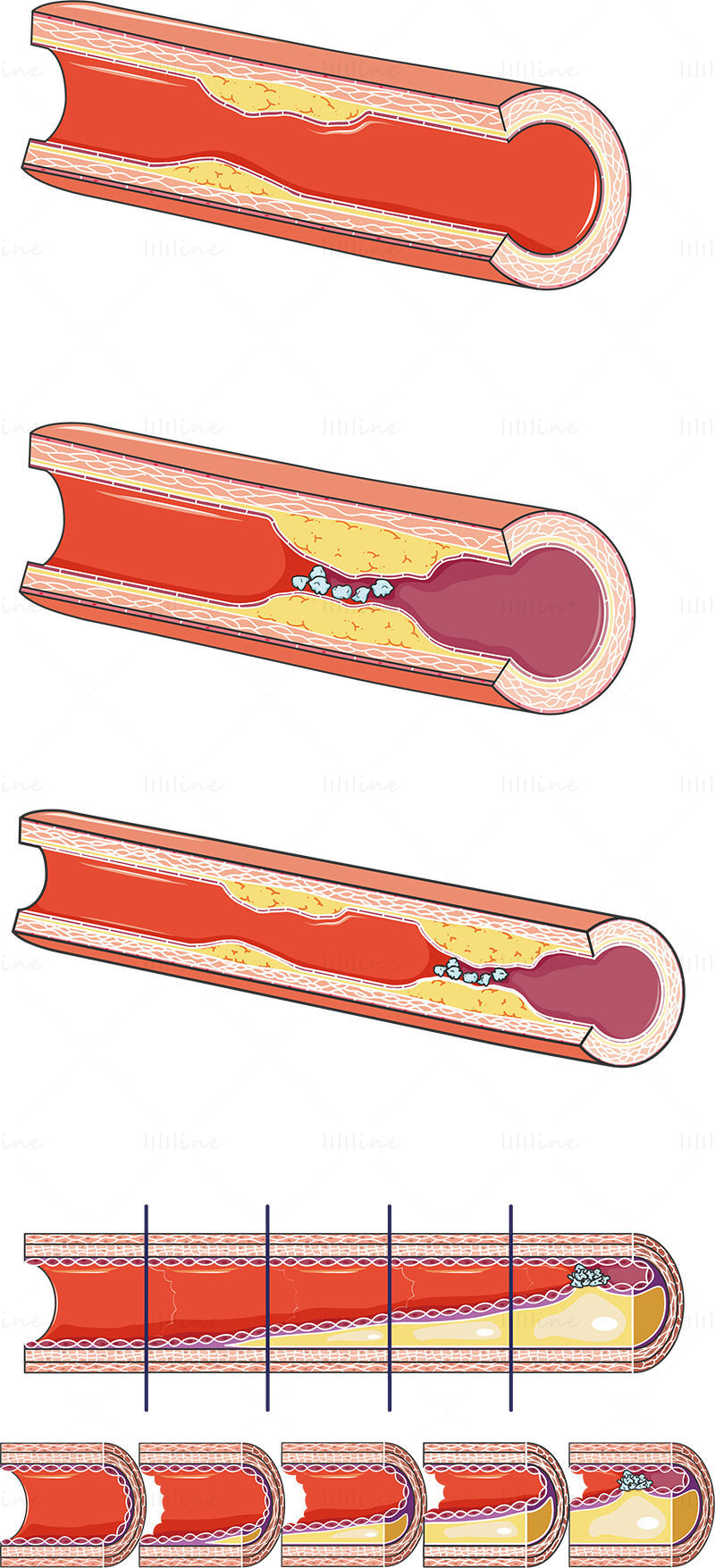 From atheroma to thrombus vector scientific illustration
