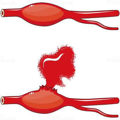 Fusiform aneurysm vector illustration